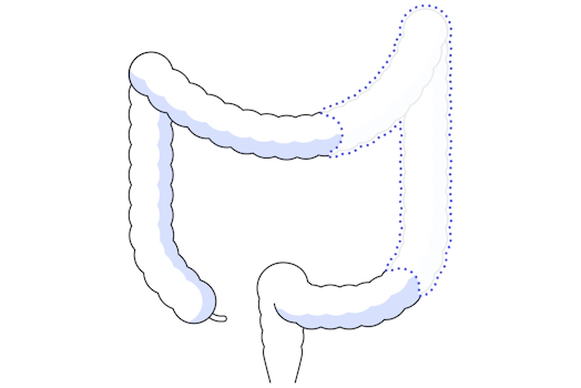Robotic Colon Resection Surgery | Da Vinci Surgery